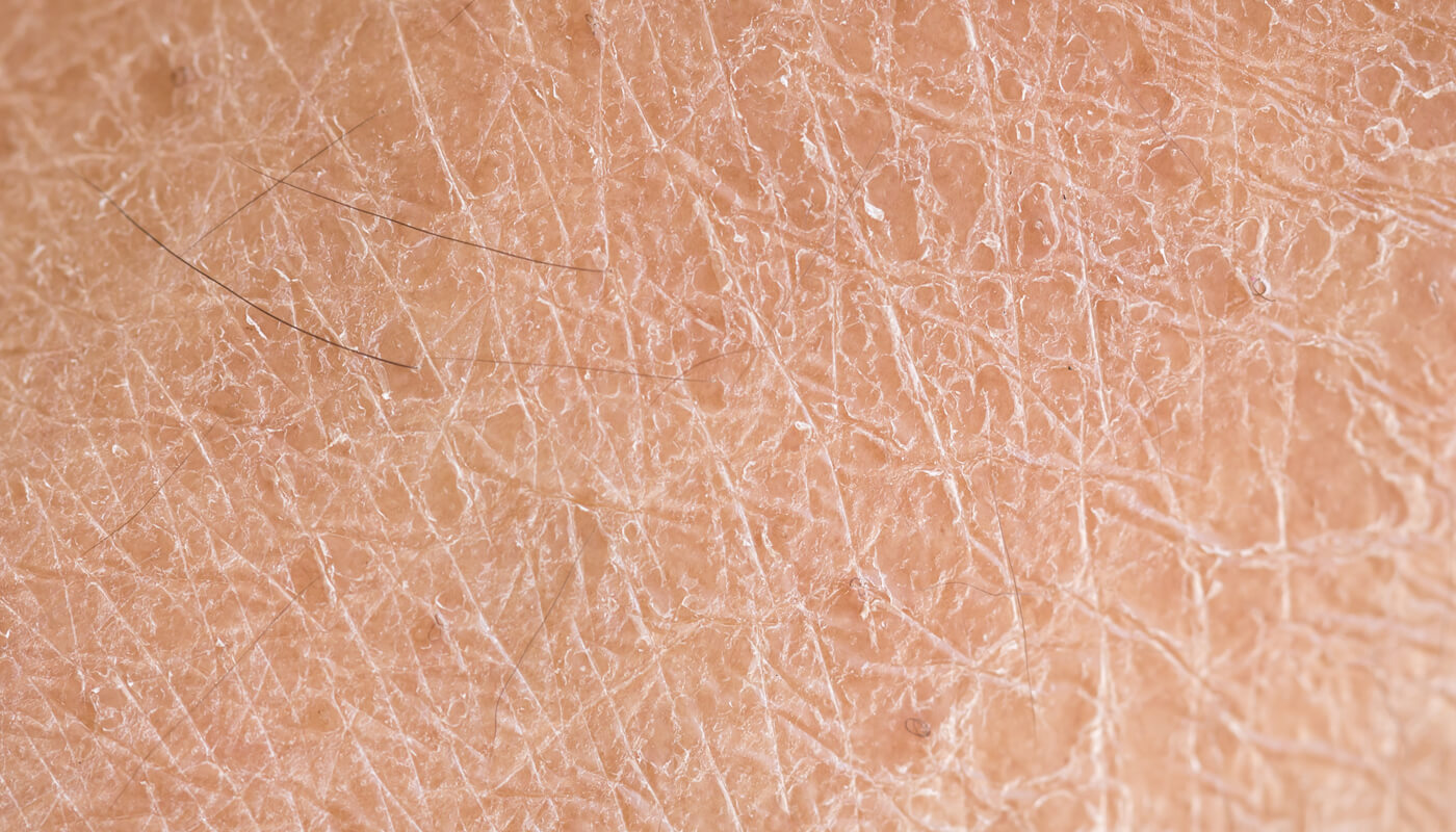 close up of dry skin