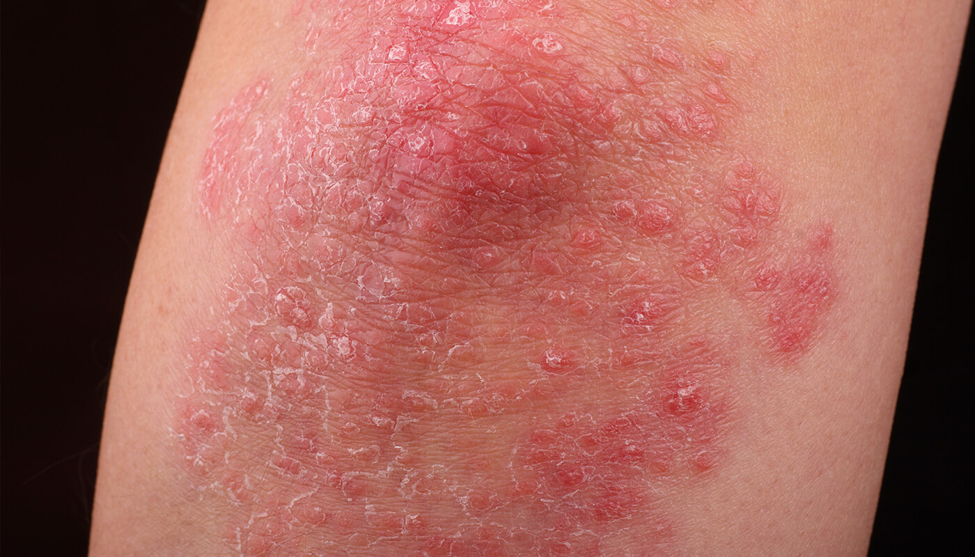 psoriasis-affected skin