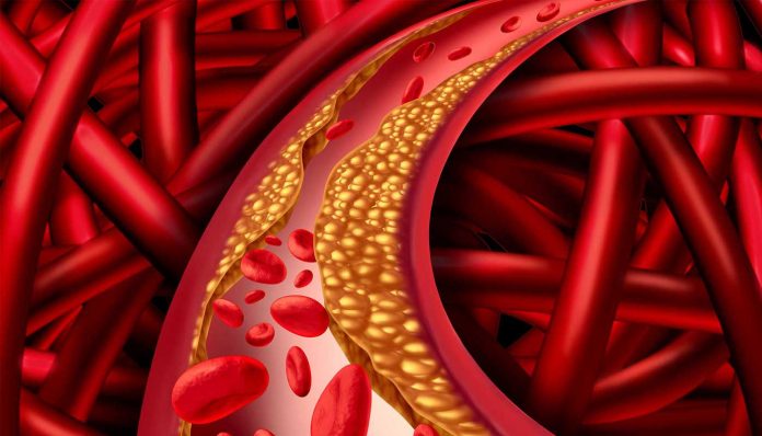cholesterol buildup in a blood vessel