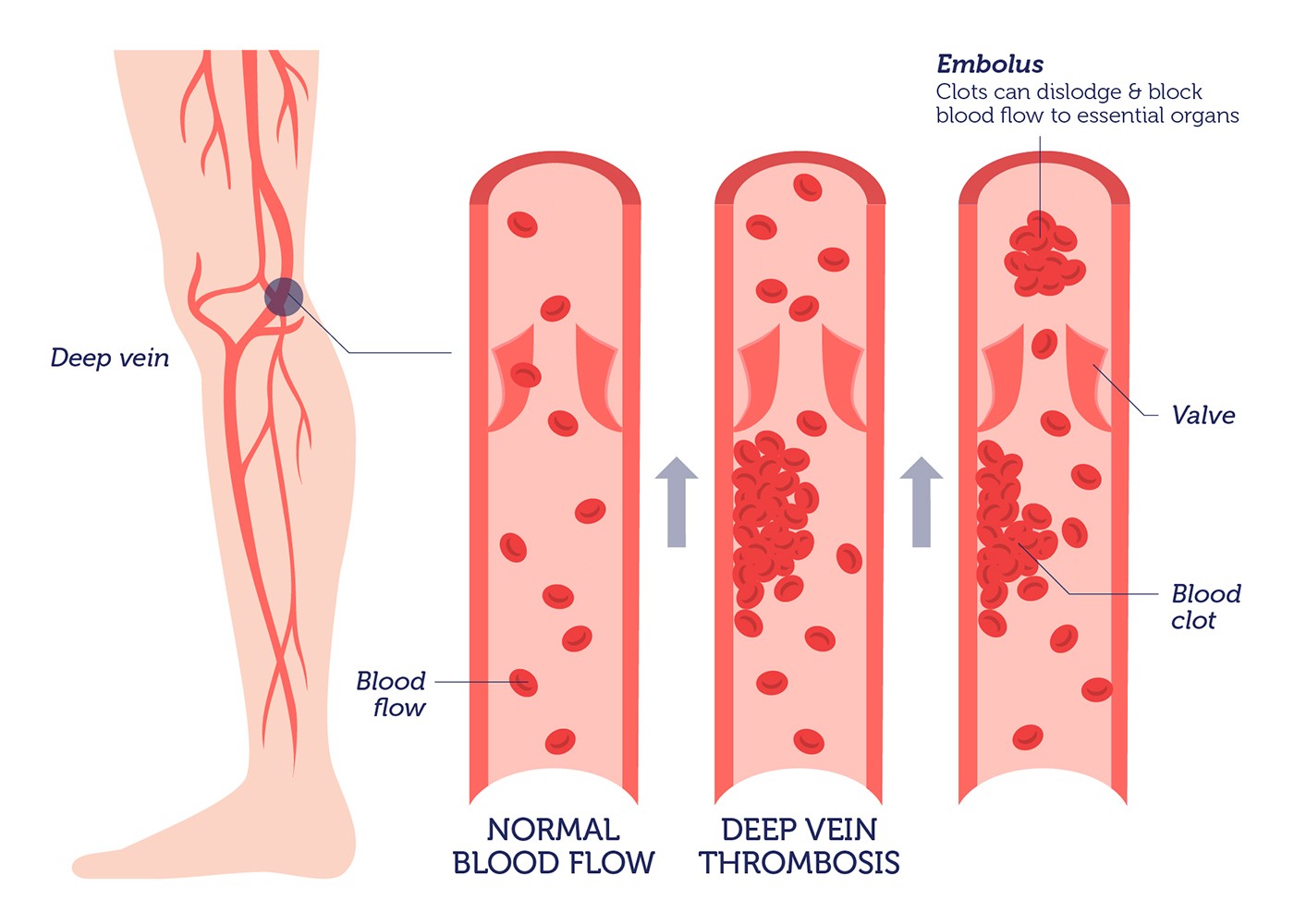 Тромб определение. Тромбоз кровеносных сосудов. Тромбоз механизм тромбообразования. Тромбоз вен нижних конечностей патогенез. Тромбоз глубоких вен нижних конечностей этиология.